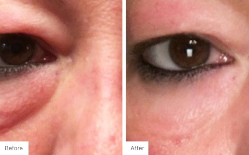 3 - Before and After Real Results photo of a woman's eye area.