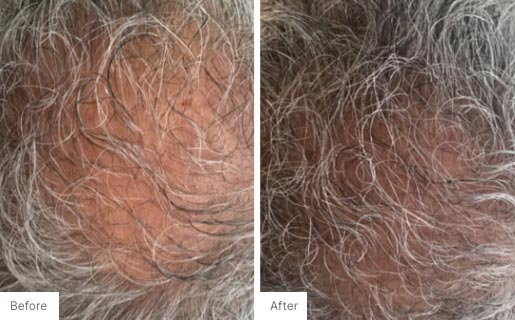 2 - Before and After Real Results picture of a man's scalp.